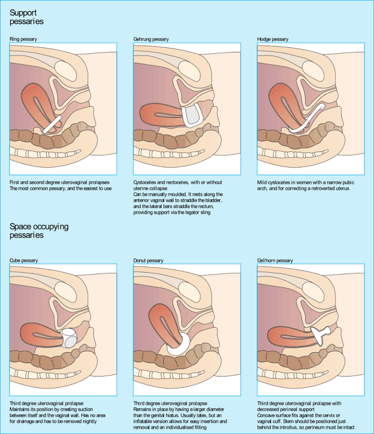 Pelvic Organ Prolapse A Problem To Understand Opal Physio