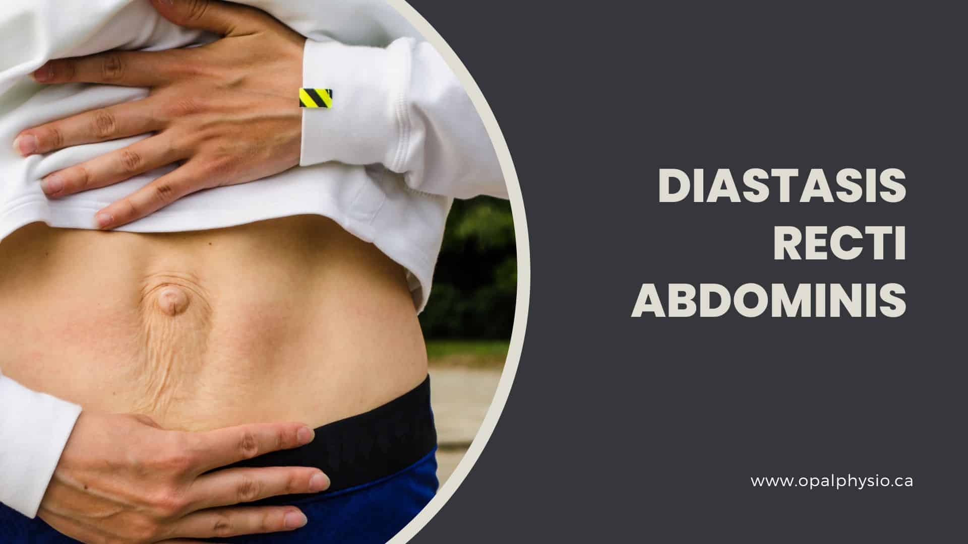 How To Check Diastasis Recti Abdominal Separation 