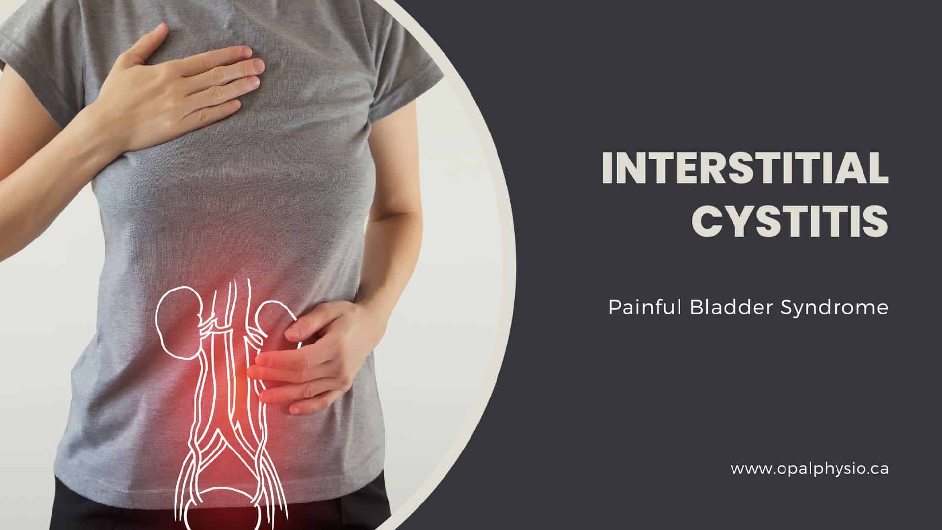 Interstitial Cystitis Treatment