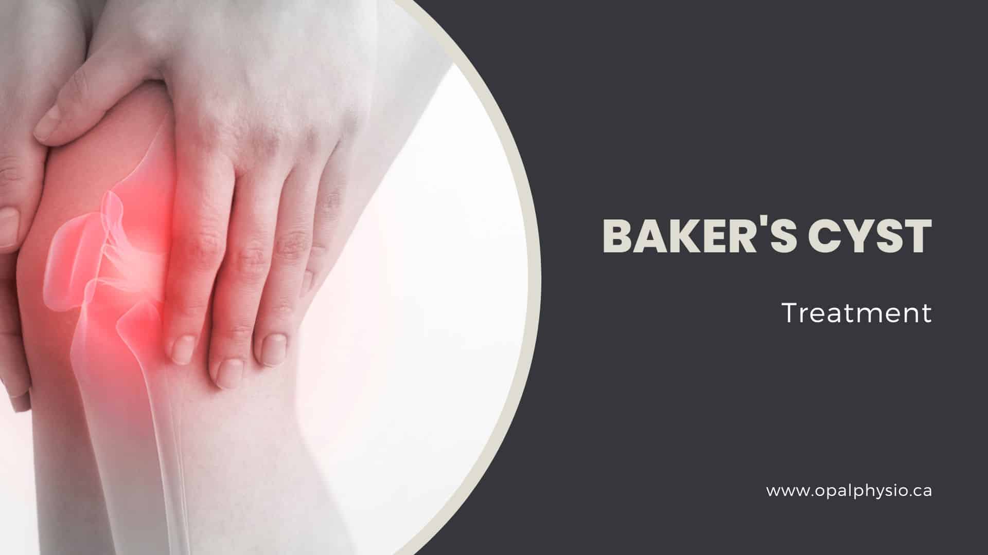 Baker Cyst: Symptoms, Causes & Treatment