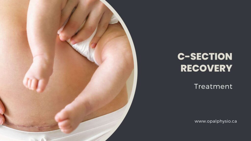 C-Section Recovery Treatment